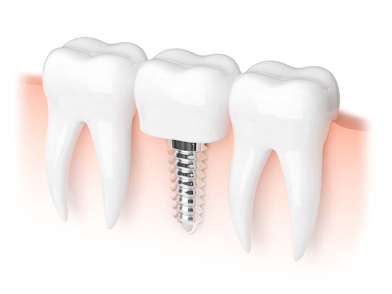 人工植牙