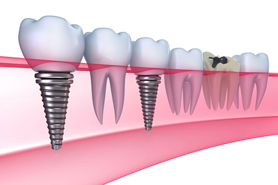 專業微創植牙｜數位科技植牙